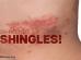 Does Medicare Cover the Shingles Vaccine? What Retirees Should Know